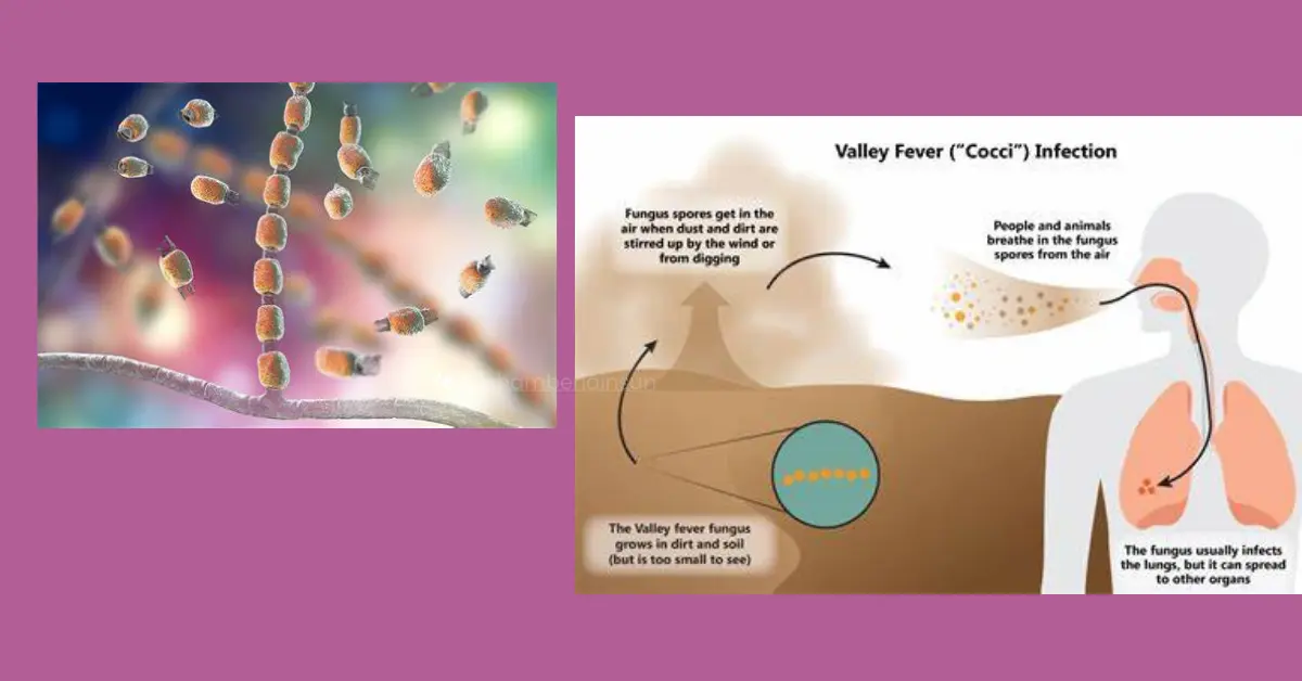 A Fungus Among Us What is Valley Fever