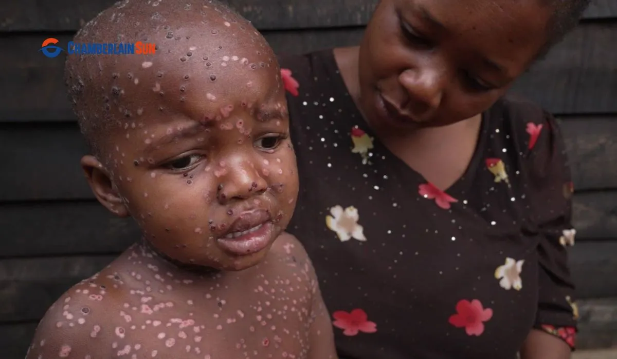 Deadly Mpox Outbreak In DRC Amplified By Severe Shortages